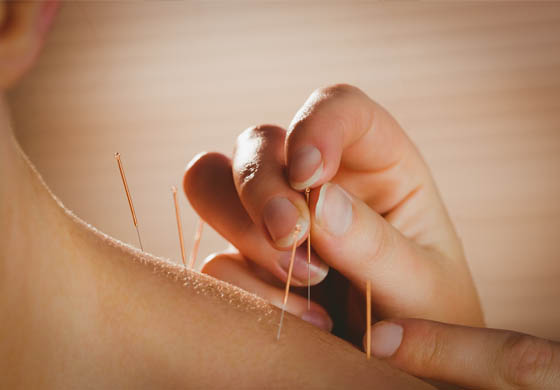Male patient receiving acupuncture in his neck and shoulder