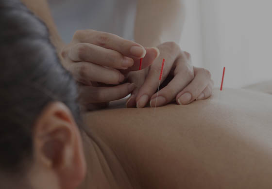 Young therapist inserts acupuncture needles on the upper back of a young female patient who is lying face down with her head tilted towards the camera